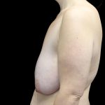 Breast Lift Before & After Patient #23705