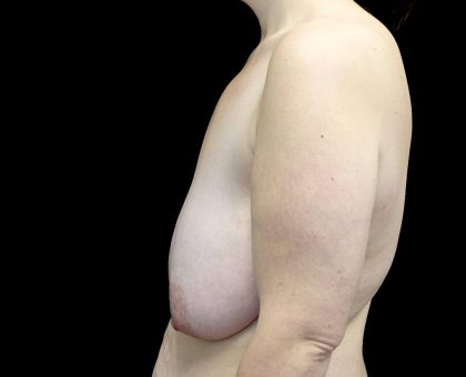 Breast Lift Before & After Patient #23705