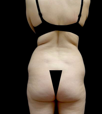 Liposuction Before & After Patient #23696