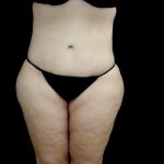 Tummy Tuck Before & After Patient #23706