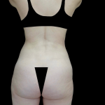 Liposuction Before & After Patient #23696