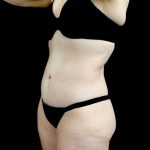 Tummy Tuck Before & After Patient #23706