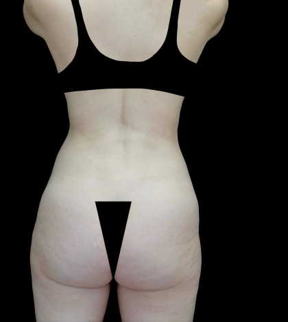 Liposuction Before & After Patient #23696