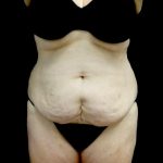 Liposuction Before & After Patient #23707