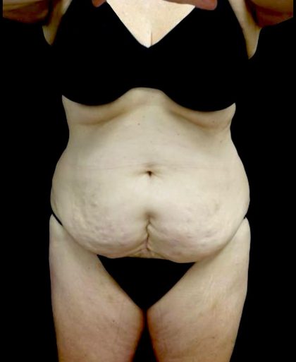 Liposuction Before & After Patient #23707