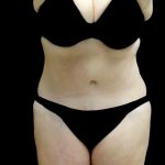 Liposuction Before & After Patient #23707