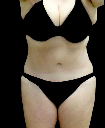 Liposuction Before & After Patient #23707