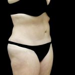 Liposuction Before & After Patient #23707