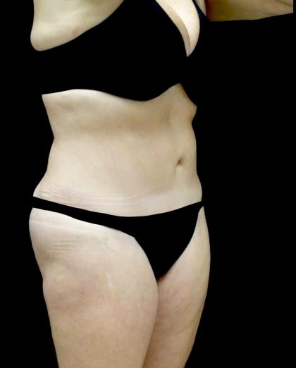 Liposuction Before & After Patient #23707