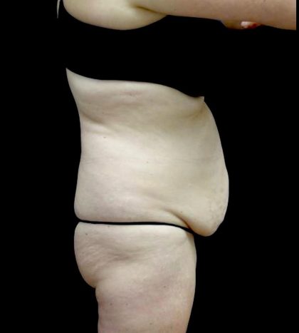 Liposuction Before & After Patient #23707