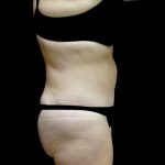 Liposuction Before & After Patient #23707