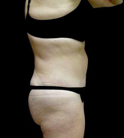 Liposuction Before & After Patient #23707