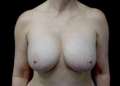 Breast Implant Removal (Explant Surgery) Before & After Patient #23709