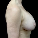 Breast Implant Removal (Explant Surgery) Before & After Patient #23709