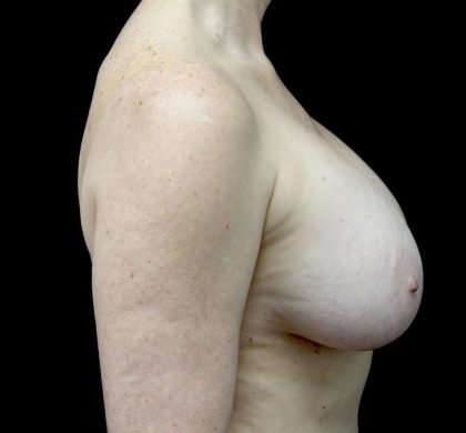 Breast Implant Removal (Explant Surgery) Before & After Patient #23709