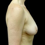 Breast Implant Removal (Explant Surgery) Before & After Patient #23709