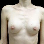 Breast Augmentation (Implants) Before & After Patient #23710