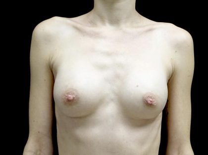 Breast Augmentation (Implants) Before & After Patient #23710