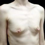 Breast Augmentation (Implants) Before & After Patient #23710