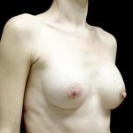 Breast Augmentation (Implants) Before & After Patient #23710