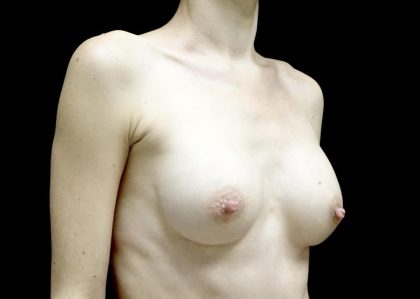 Breast Augmentation (Implants) Before & After Patient #23710