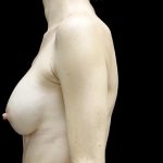 Breast Augmentation (Implants) Before & After Patient #23710