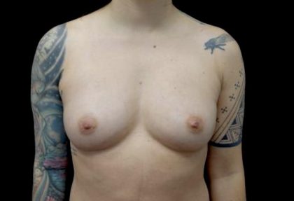 Breast Augmentation (Fat Transfer) Before & After Patient #23776