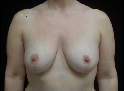 Breast Augmentation (Fat Transfer) Before & After Patient #23778