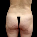 Buttock Augmentation Before & After Patient #23779