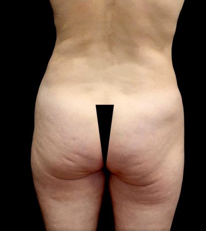 Buttock Augmentation Before & After Patient #23779