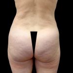 Buttock Augmentation Before & After Patient #23779