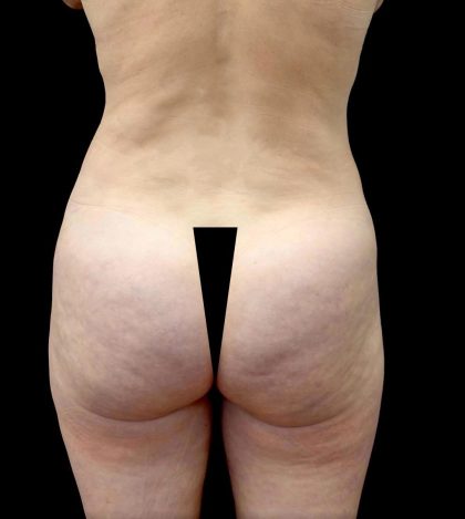 Buttock Augmentation Before & After Patient #23779