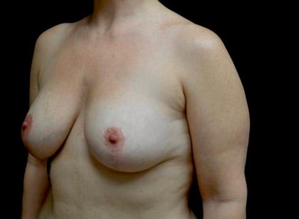 Breast Augmentation (Fat Transfer) Before & After Patient #23778