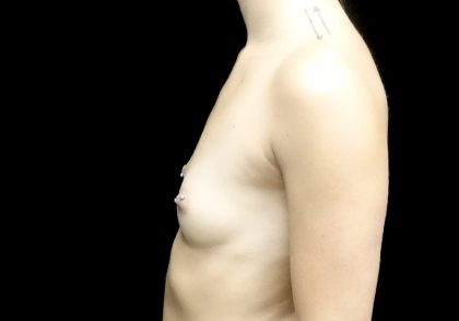 Breast Augmentation (Fat Transfer) Before & After Patient #23776