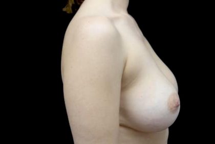 Breast Implant Removal (Explant Surgery) Before & After Patient #23777