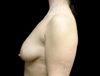 Breast Augmentation (Fat Transfer) Before & After Patient #23778