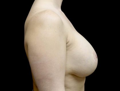 Breast Lift with Implants Before & After Patient #23912