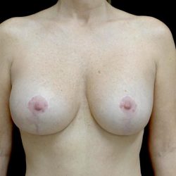 Breast Lift with Implants Before & After Patient #24010