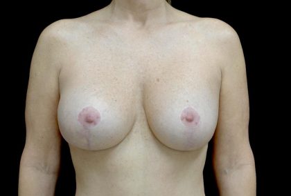 Breast Lift with Implants Before & After Patient #24010