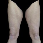 Thighplasty Before & After Patient #24071