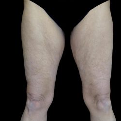 Thighplasty Before & After Patient #24071