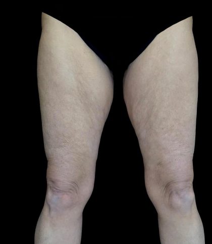 Thighplasty Before & After Patient #24071
