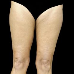 Thighplasty Before & After Patient #24071