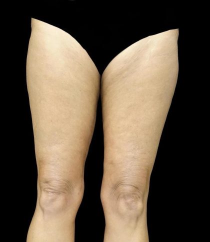 Thighplasty Before & After Patient #24071