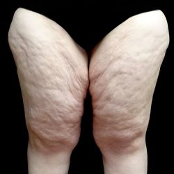 Thighplasty Before & After Patient #24093