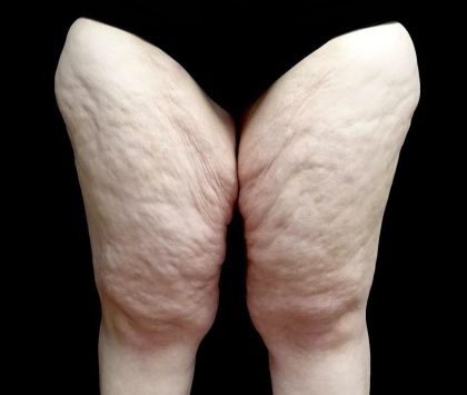 Thighplasty Before & After Patient #24093