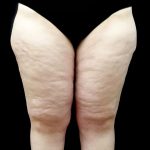 Thighplasty Before & After Patient #24093