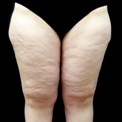 Thighplasty Before & After Patient #24093