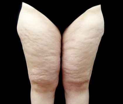 Thighplasty Before & After Patient #24093