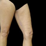 Thighplasty Before & After Patient #24071